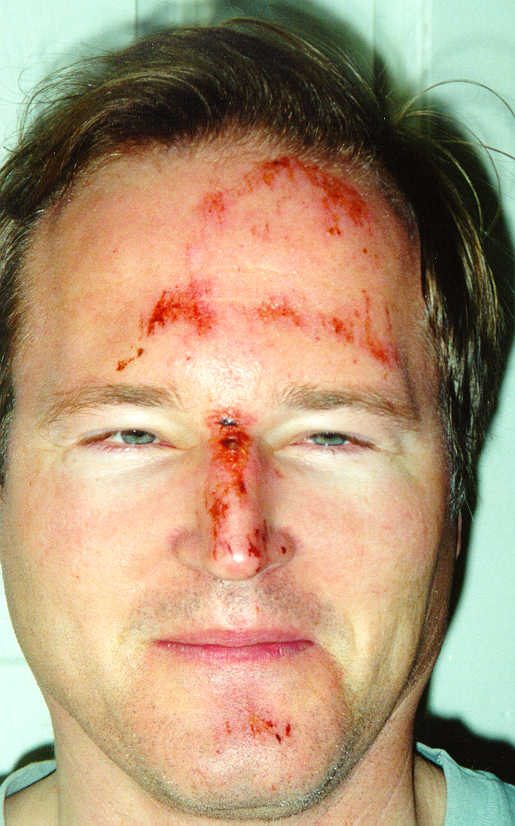 ski_crash.jpg (53526 bytes)